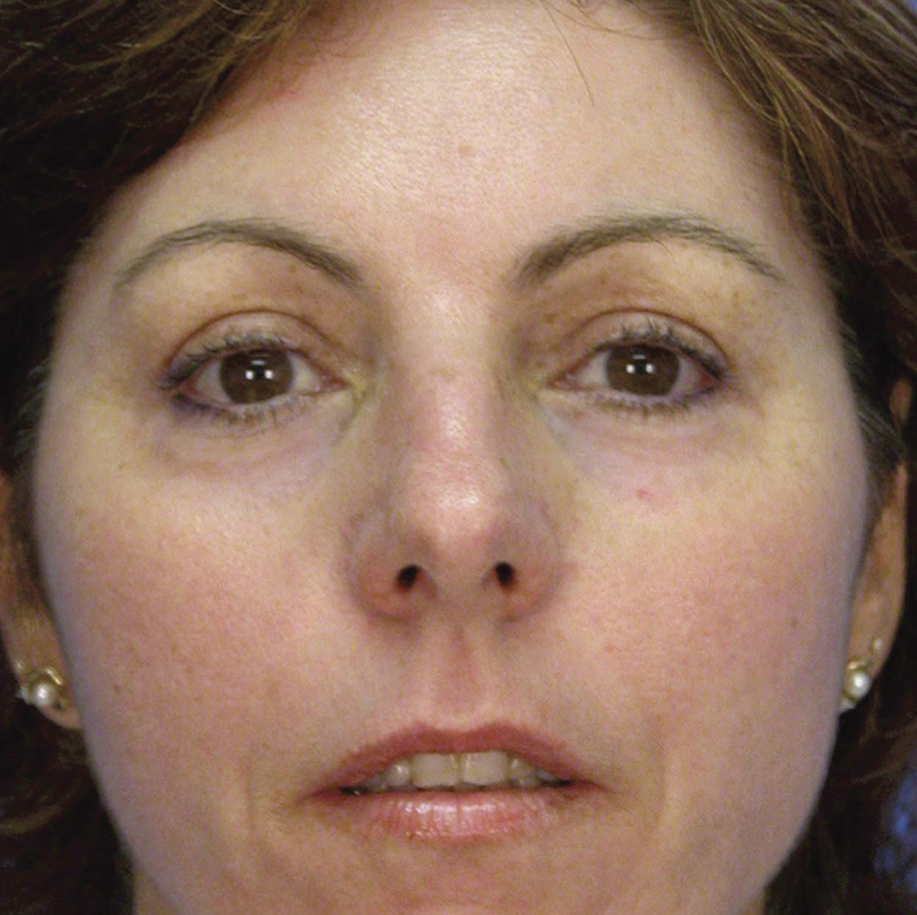 Microlaserpeel After Treatment Image